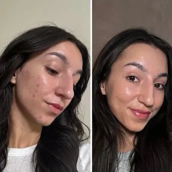 Antes e depois — Beatriz Ornellas