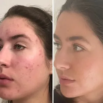Antes e depois — Roberta Vieira