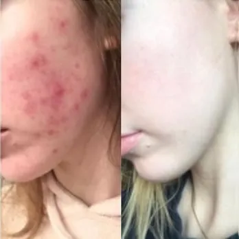 Antes e depois — Amanda Brito
